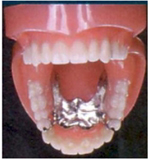 Hidden Partial Dentures
