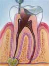 Dental Root Canal / Endodontic