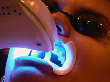 Dental Tooth Whitening